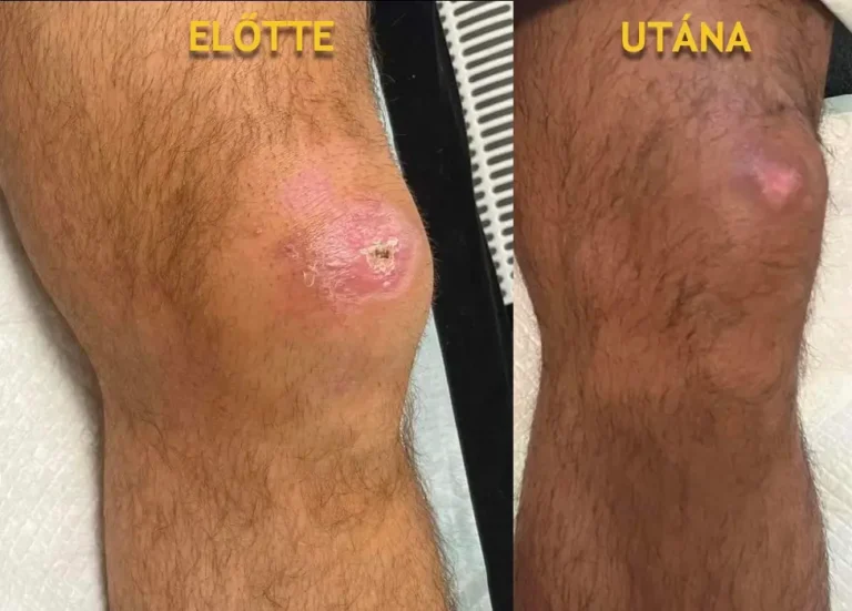 1_térd kelés előtte-utána