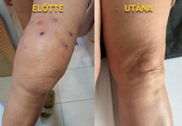 2_térd duzzanat előtte-utána