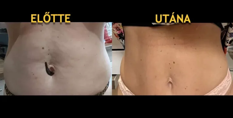 3_has vizesedés előtte-utána