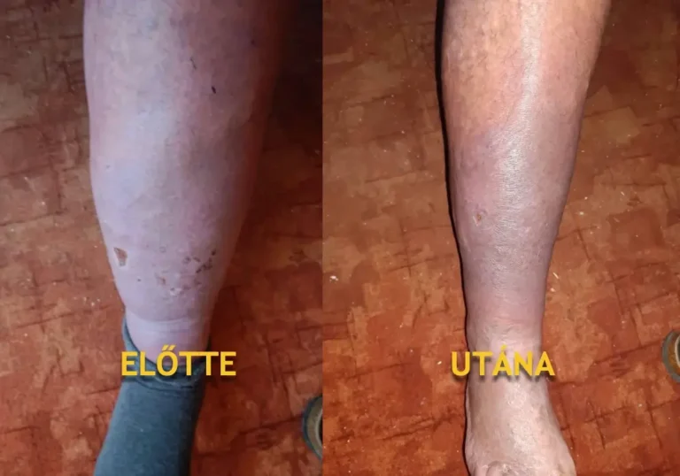 5_lábszár duzzanat előtte-utána
