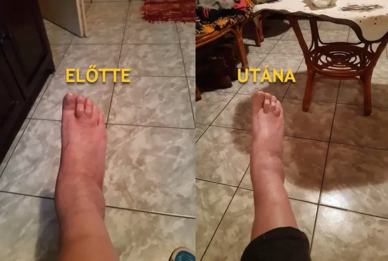 6_lábduzzanat előtte-utána